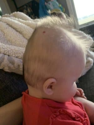 Baby Hinterkopf abgeflacht seitlich gesehen